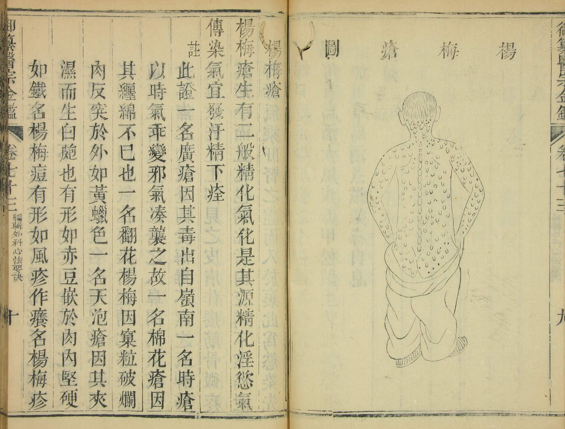 Two facing pages in an open book. The page on the left is filled with Chinese characters. On the right is a drawing of a man whose pants are lowered beneath his hips and whose naked back is covered with spots.