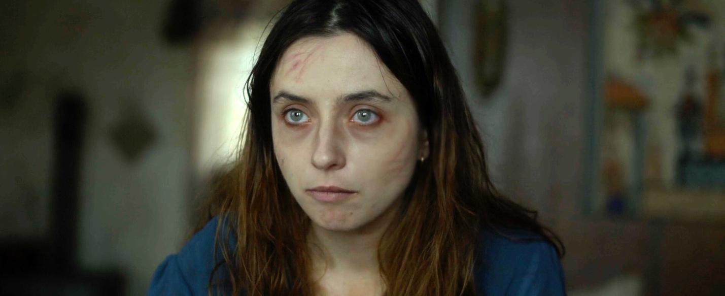 A close-up view of a young woman with dark circles around her eyes and dry, scratched skin on her face. 